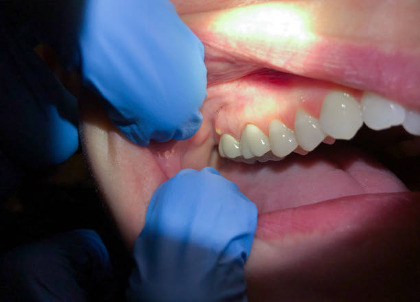 Best Emergency Treatment for Oral Infections in Cape Coral, FL