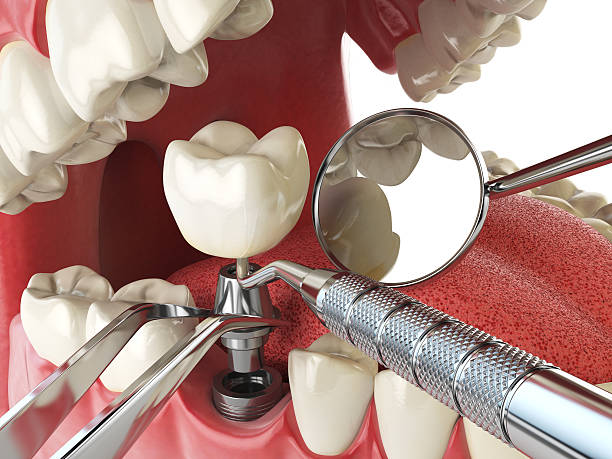 Best Knocked-Out Tooth (Avulsed Tooth) Treatment in Cape Coral, FL